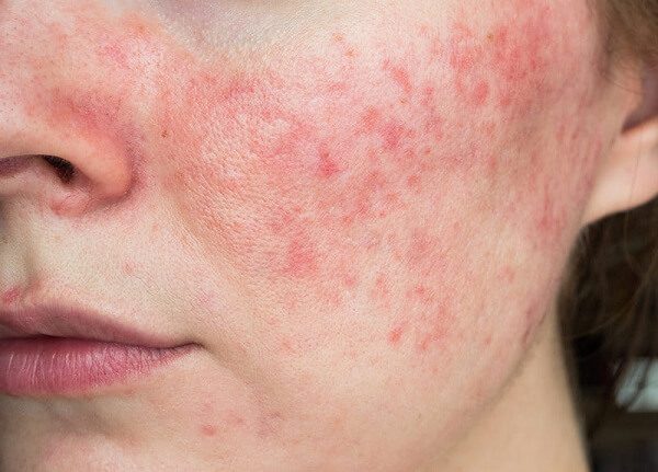 Hiểu rõ nguyên nhân để biết cách giảm đỏ cho da nhạy cảm