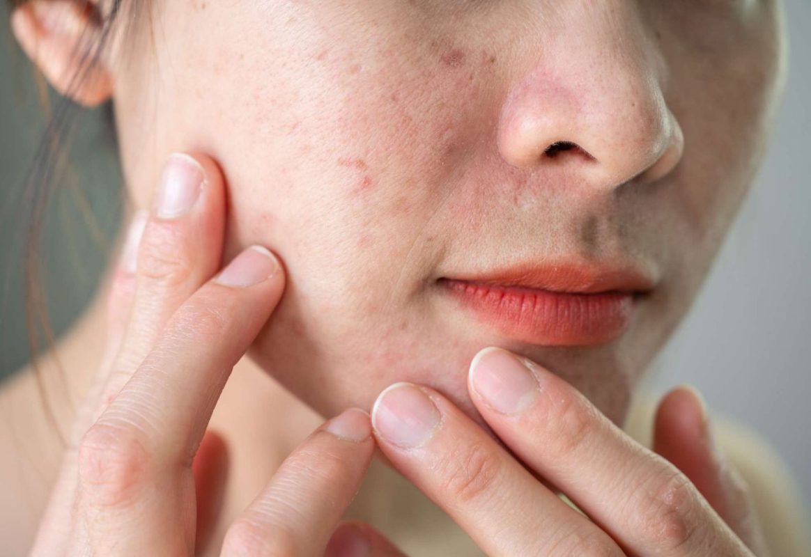 Cách chăm sóc da nhạy cảm đúng cách để ngăn ngừa tình trạng đỏ da
