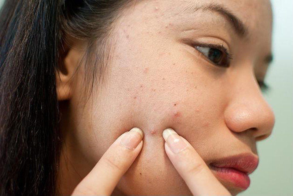 Tại sao nên áp dụng cách nặn mụn theo mẹo dân gian?