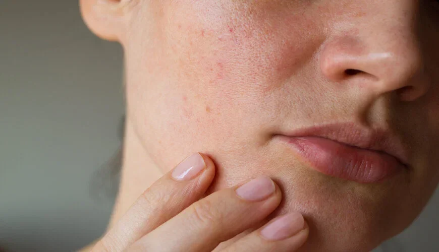Nguyên nhân khiến da hỗn hợp thiên khô trở nên mất cân bằng