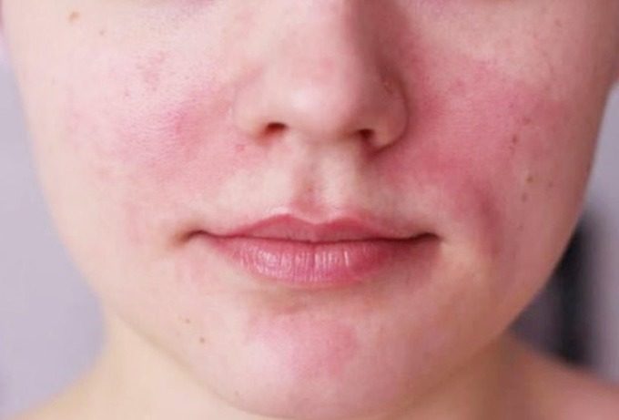 Biết cách nhận biết da nhạy cảm bạn sẽ hiểu được cách chăm sóc làn da này