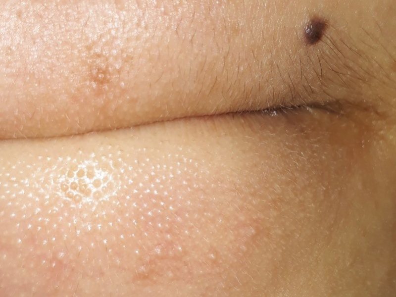 Hiểu rõ các nguyên nhân này là bước đầu tiên trong quá trình lựa chọn cách trị mụn cám phù hợp và hiệu quả.
