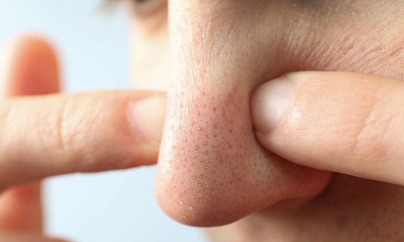 Nếu các biện pháp thiên nhiên không mang lại hiệu quả mong muốn, bạn có thể lựa chọn các sản phẩm đặc trị chứa hoạt chất khoa học, có cơ chế tác động trực tiếp lên nhân mụn.