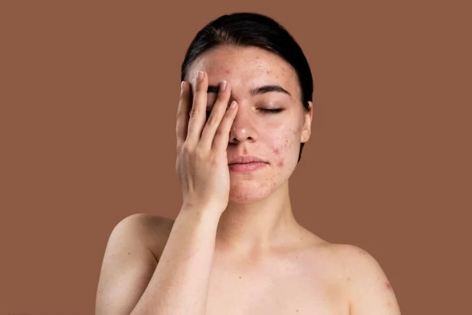 Cách chăm sóc da bị căng thẳng hiệu quả