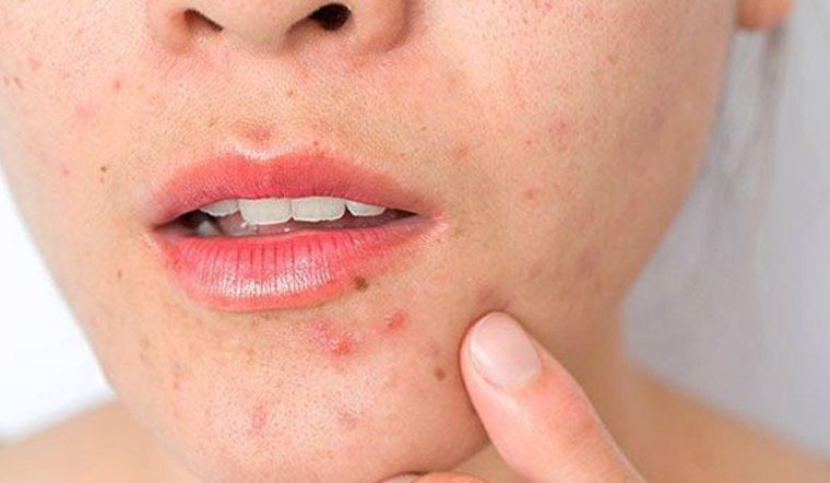 Các thói quen sinh hoạt cần thay đổi để ngăn ngừa mụn