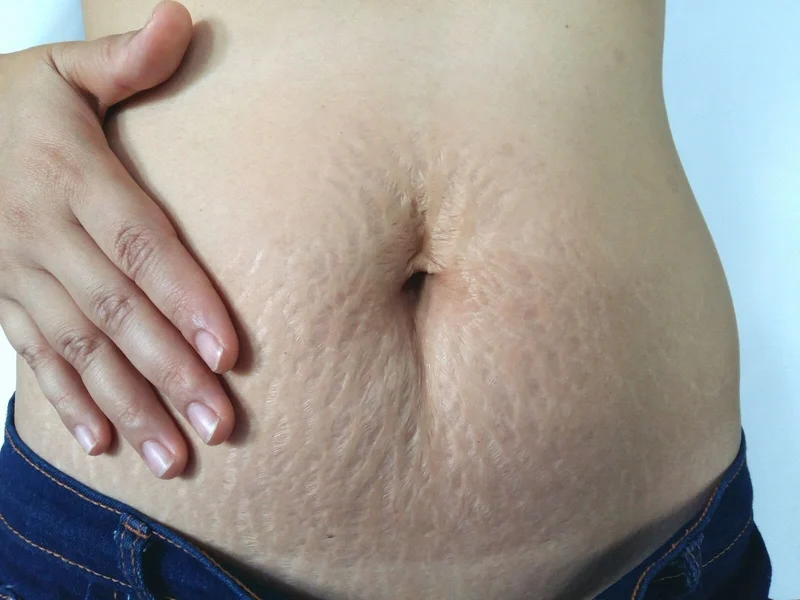 Ngoài ra, việc chia nhỏ bữa ăn, giảm tinh bột tinh luyện và tránh nhịn ăn đột ngột cũng giúp cơ thể và làn da thích nghi dễ dàng hơn với quá trình giảm cân.