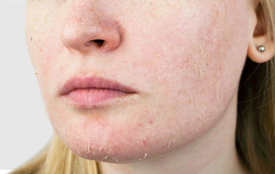 Mặc dù da nhạy cảm có thể gặp phải nguy cơ kích ứng khi sử dụng BHA, nhưng nếu sử dụng đúng cách và với sản phẩm phù hợp, BHA vẫn có thể mang lại nhiều lợi ích cho làn da này.