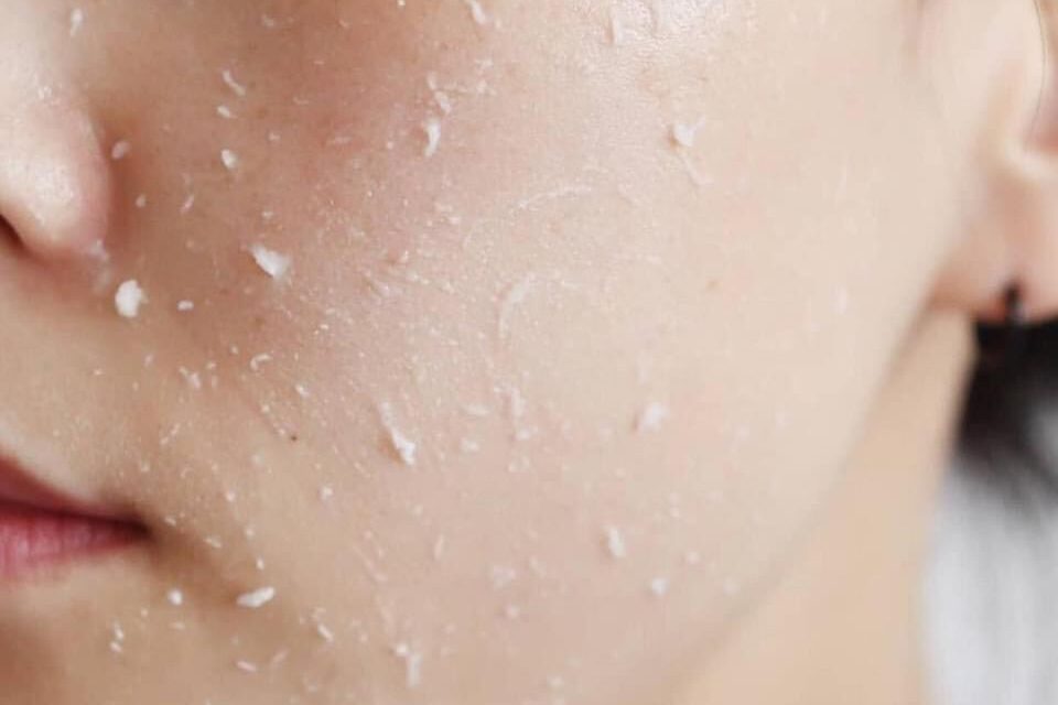 Sự kiên nhẫn và hiểu rõ làn da của mình chính là chìa khóa giúp người có làn da nhạy cảm tìm ra sản phẩm tẩy tế bào chết lý tưởng, giúp da khỏe mạnh mà không phải đánh đổi bằng sự tổn thương.