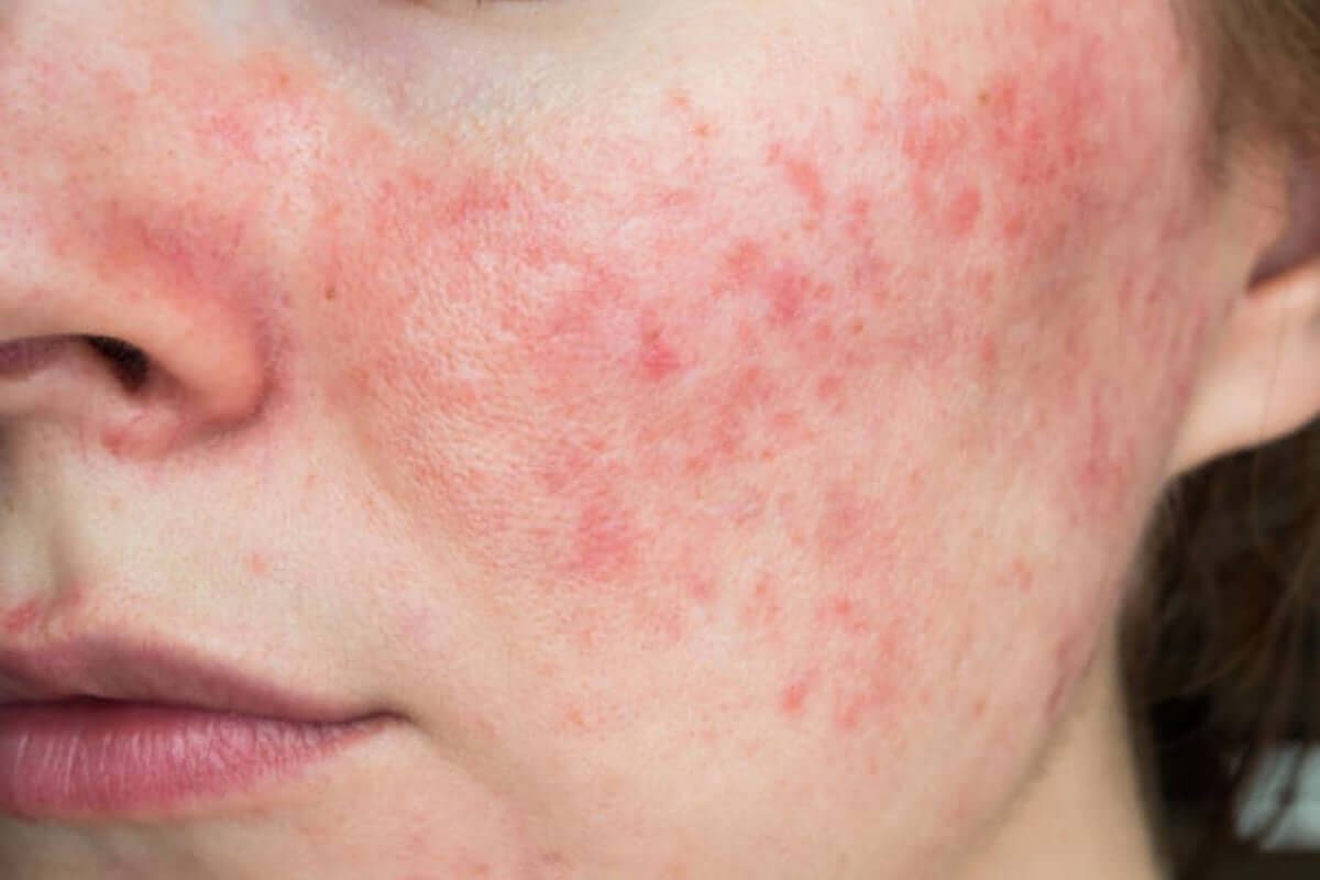 Da nhạy cảm là da gì? Hiểu đúng để chăm sóc đúng