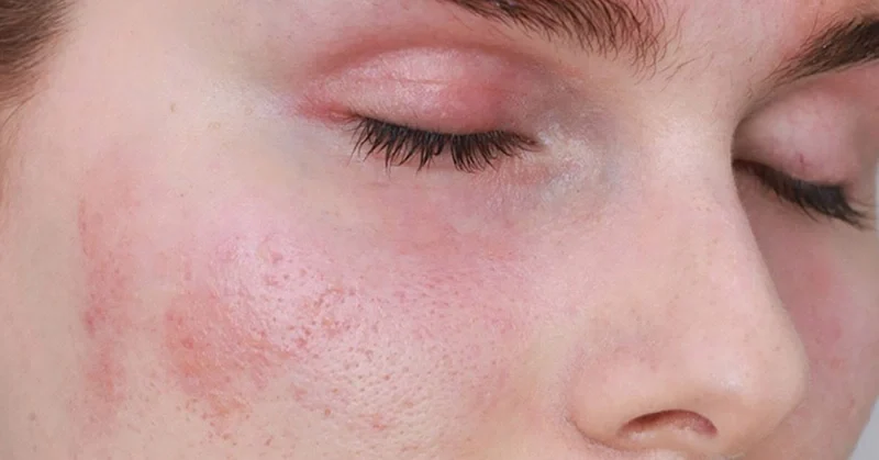 Cách chăm sóc da nhạy cảm sần sùi hiệu quả