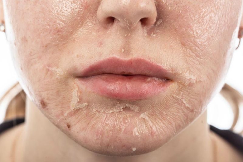 Với những cách chăm sóc da hợp lý, làn da nhạy cảm sau lăn kim sẽ nhanh chóng phục hồi, khỏe mạnh và trở lại trạng thái căng mịn.