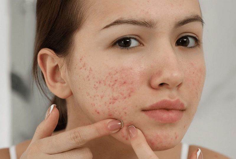 Nguyên nhân da nhạy cảm sau nặn mụn