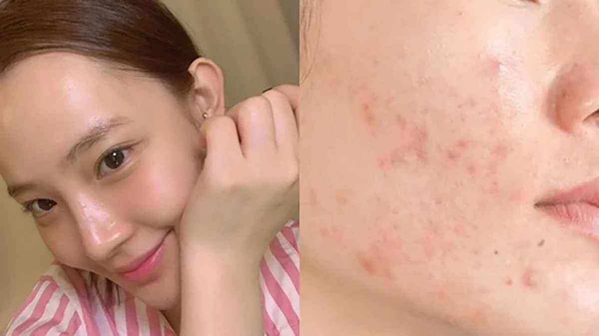 Cách phục hồi da nhạy cảm sau nặn mụn sao cho hiệu quả