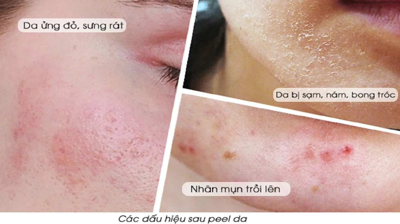 Những lưu ý quan trọng khi chăm sóc da nhạy cảm sau peel