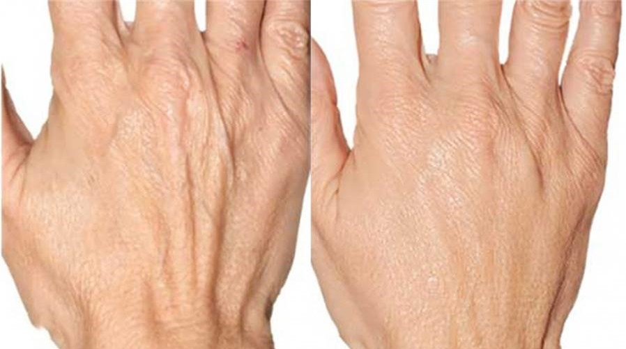 Những yếu tố này khiến làn da tay nhăn nheo bẩm sinh dễ nhăn và kém đàn hồi mặc dù người bệnh vẫn còn trẻ hoặc đang trong độ tuổi phát triển.
