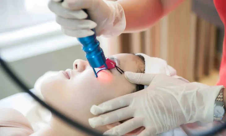 Đốt tàn nhang là gì? Cơ chế hoạt động của các phương pháp phổ biến