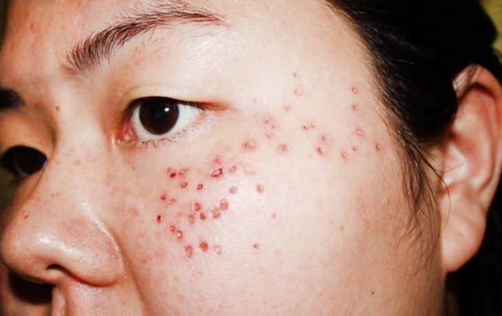 Việc đánh giá chính xác tình trạng da cần được thực hiện bởi bác sĩ chuyên khoa để xác định có nên can thiệp bằng công nghệ đốt hay không.