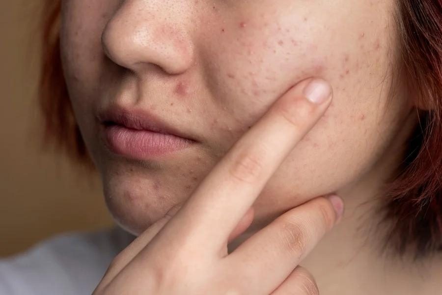 Cách Khắc Phục Tình Trạng Mụn Khi Dùng Niacinamide