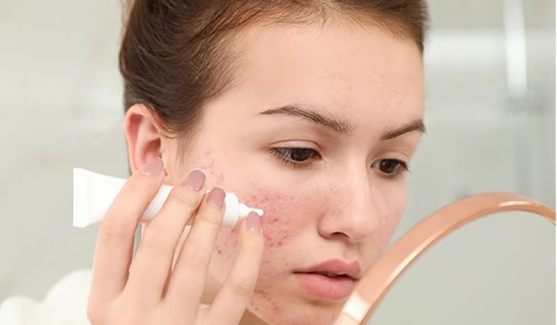 Việc sử dụng gel chấm mụn mủ đúng cách không chỉ giúp cải thiện tình trạng mụn mà còn hạn chế được các biến chứng như viêm da, thâm sẹo và tái phát mụn về sau.