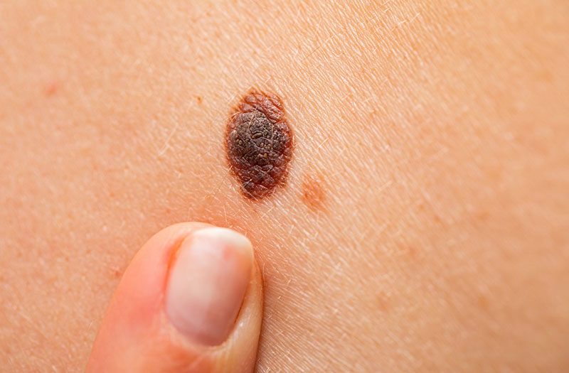 Những lưu ý khi dùng gel tẩy nốt ruồi tàn nhang