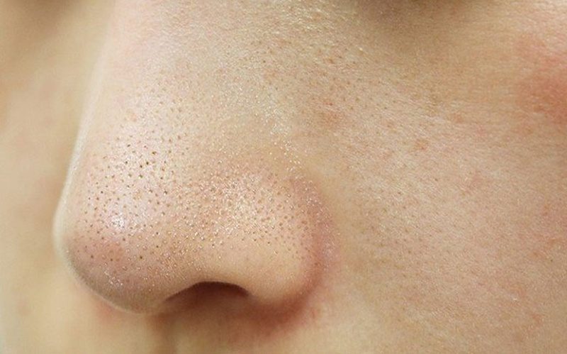 Nguyên nhân hình thành mụn cám và vai trò của kem trị mụn cám