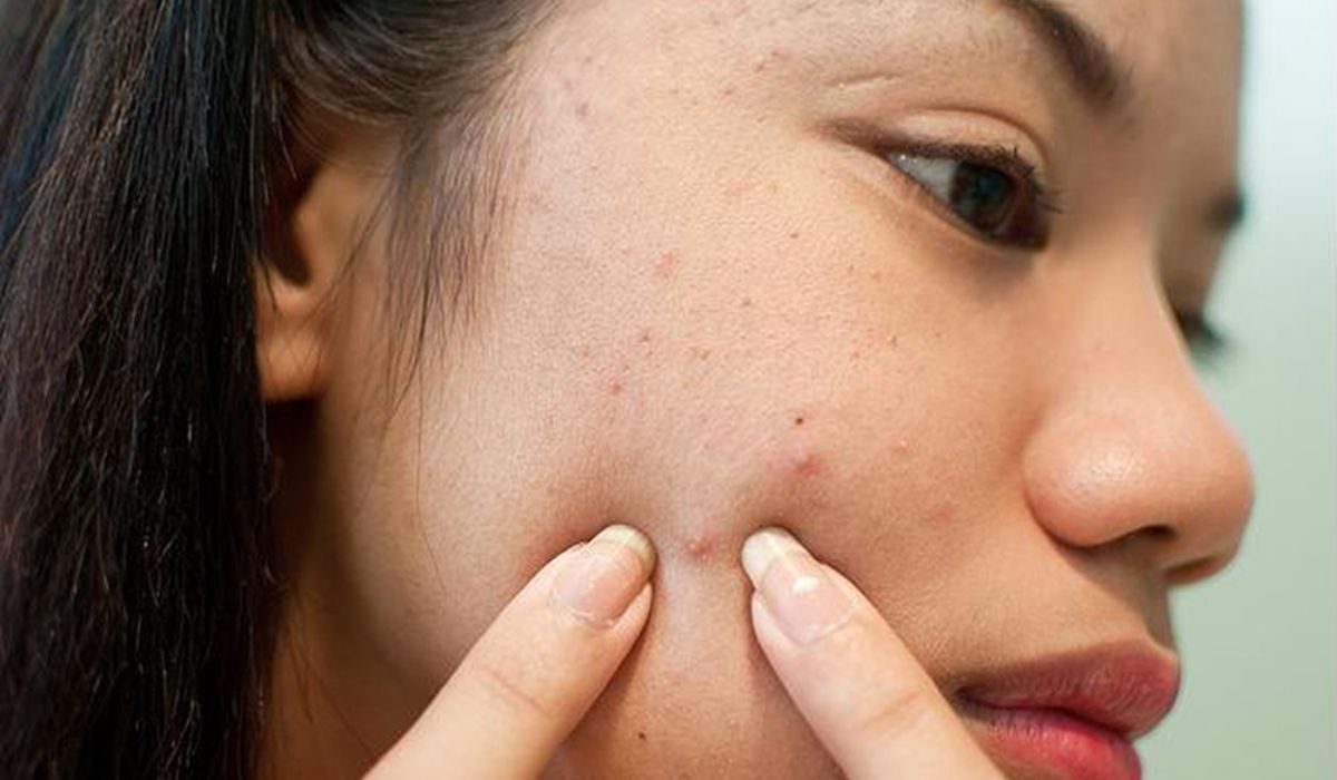 Mụn là gì? Không nặn mụn có tự hết không