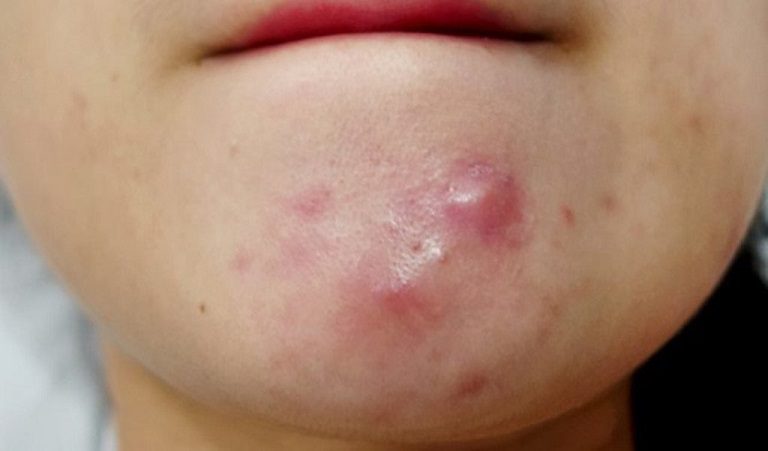 Hiểu rõ nguyên nhân mụn bọc để biết kiêng ăn gì khi bị mụn bọc