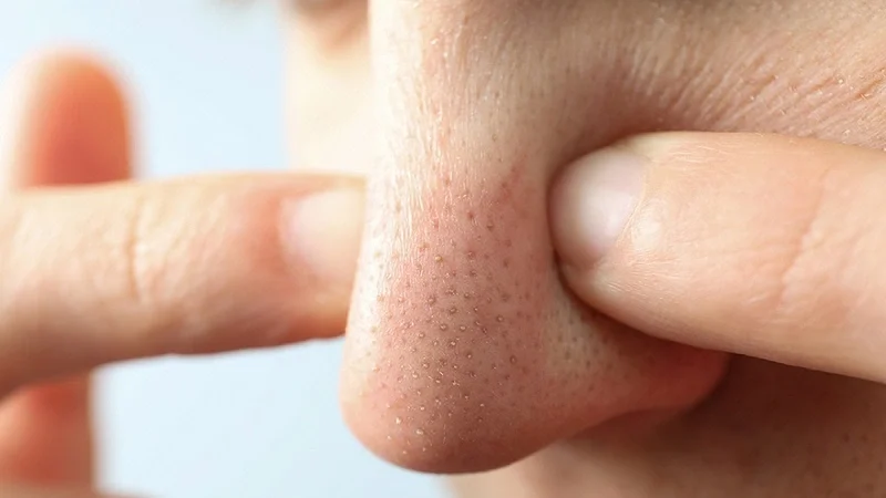 Cùng tìm hiểu các phương pháp lột mụn đầu đen hiệu quả