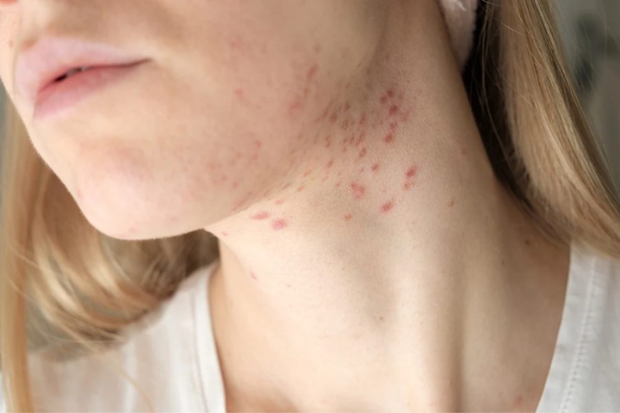 Nguyên nhân nào gây mụn ẩn dưới da ở quai hàm