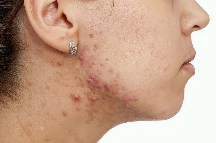 Đâu là giải pháp trị mụn ẩn dưới da ở quai hàm hiệu quả
