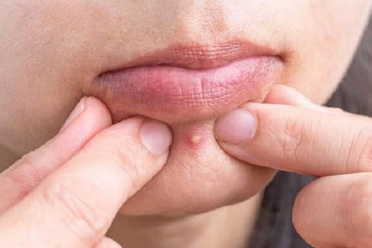 Làm thế nào để phòng ngừa mụn bọc ở cằm
