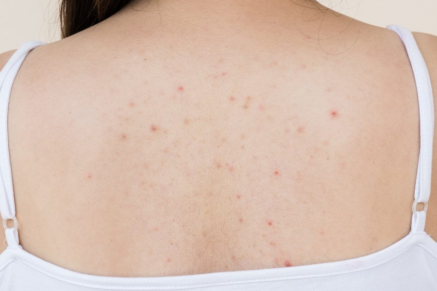 Nguyên nhân gây mụn cám ở lưng: Hiểu để phòng tránh hiệu quả