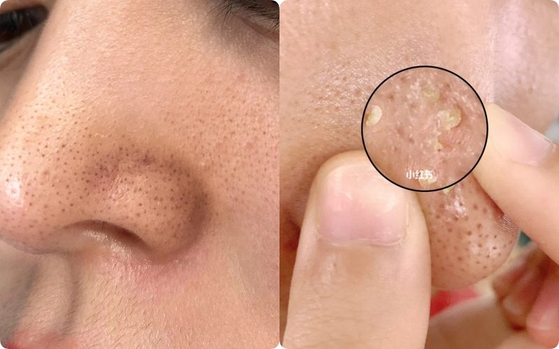 Sự hoạt động quá mức của tuyến bã nhờn gây hình thành mụn đầu đen