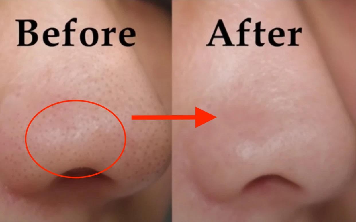 Các phương pháp điều trị mụn đầu đen hiệu quả hiện nay