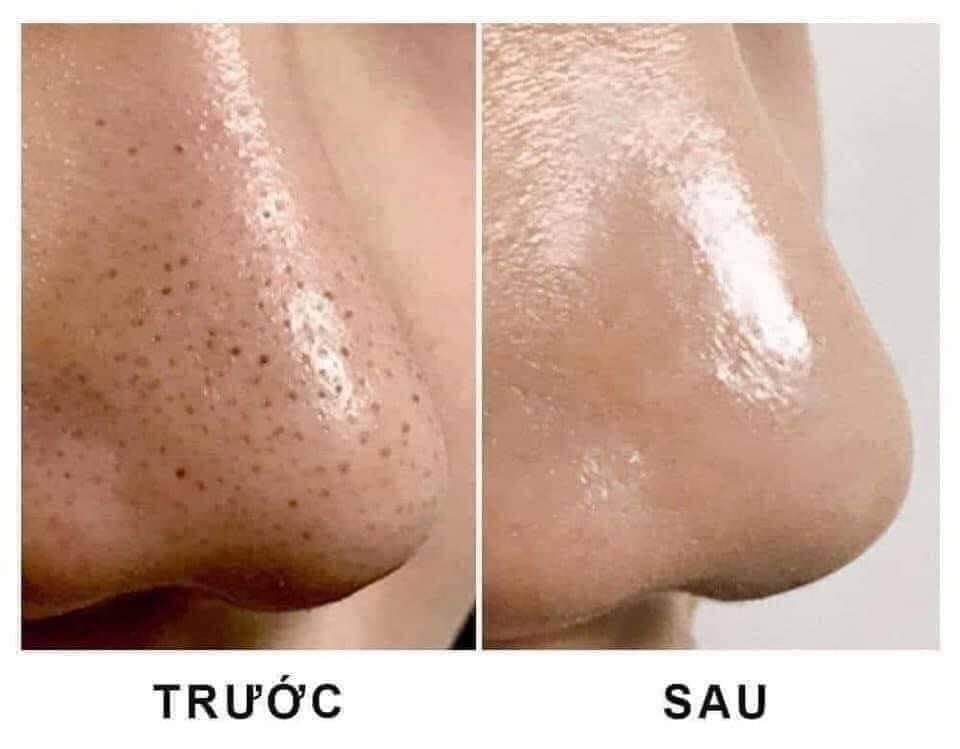 Để xử lý mụn đầu đen một cách khoa học và tránh gây tổn thương cho da, cần tuân thủ các nguyên tắc chăm sóc da nghiêm ngặt
