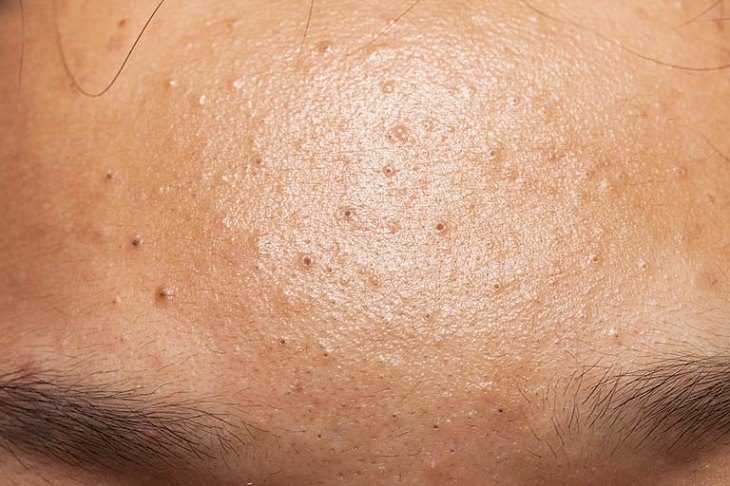 Hiểu rõ nguyên nhân gây mụn đầu đen ở trán giúp bạn tìm được cách khắc phục hiệu quả