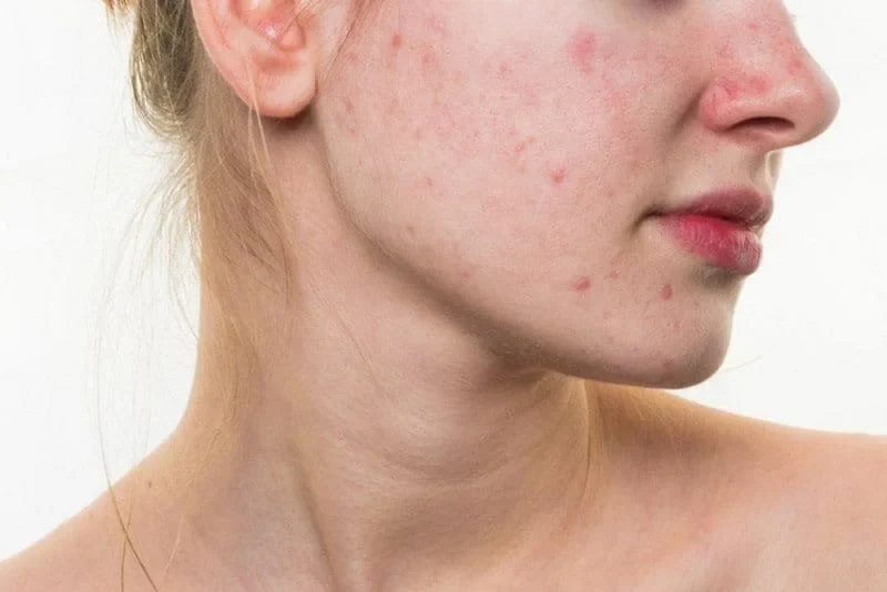 Mụn dị ứng là gì? Mụn dị ứng có phải là mụn viêm không?