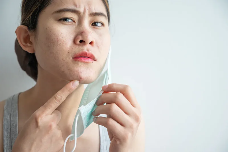 Môi trường bí bách khiến tình trạng mụn do đeo khẩu trang y tế ngày càng trầm trọng