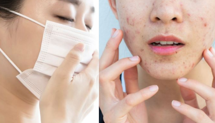 Chăm sóc da mụn do đeo khẩu trang y tế sao cho hiệu quả