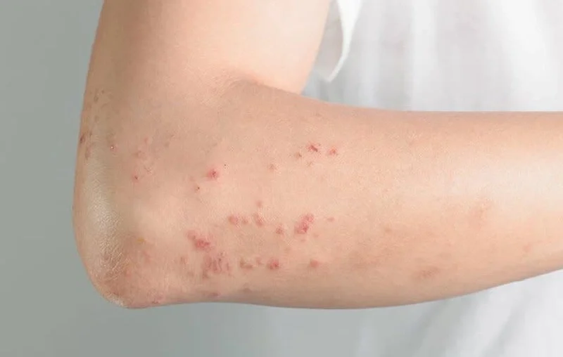 Tìm hiểu nguyên nhân gây mụn do dị ứng thực phẩm