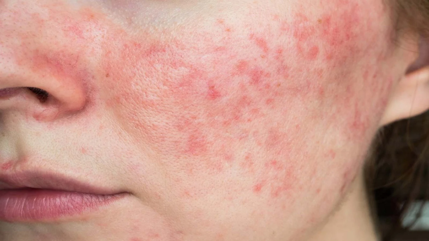 Xử lý mụn do dị ứng thực phẩm đúng cách