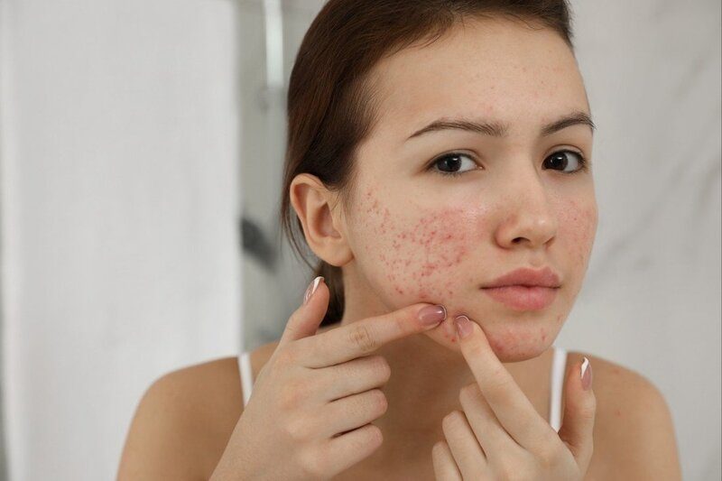 Đây là dấu hiệu cho thấy làn da đã bị “ngộ độc” mỹ phẩm và cần được phục hồi đúng cách.