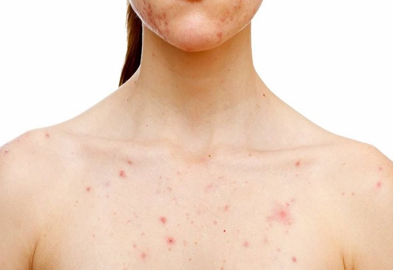 Gan bị quá tải độc tố trong thời gian dài sẽ ảnh hưởng đến tuần hoàn máu và các tuyến bã nhờn, từ đó sinh ra mụn viêm, mụn bọc hoặc mụn trứng cá.