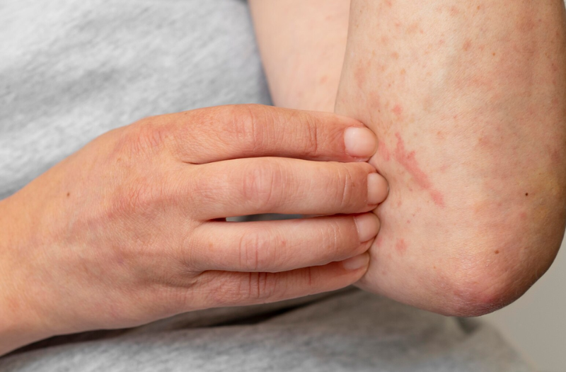 Việc phối hợp nhiều biện pháp cùng lúc, duy trì trong thời gian dài sẽ giúp cải thiện đáng kể tình trạng mụn do gan nóng mà không cần dùng đến các loại thuốc mạnh gây tác dụng phụ.