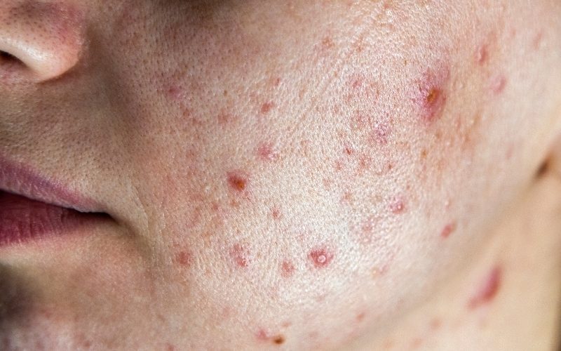 Nội tiết tố thay đổi khiến mụn do rối loạn nội tiết ngày càng nhiều