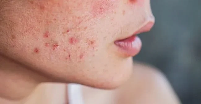 Mụn do stress kéo dài do thay đổi tiện tố, hormon trong giai đoạn stress