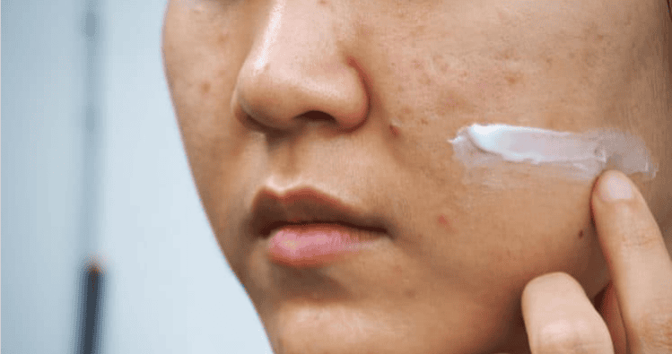 Nhận biết chính xác loại mụn giúp tiết kiệm thời gian điều trị và tránh làm tổn thương da không cần thiết.