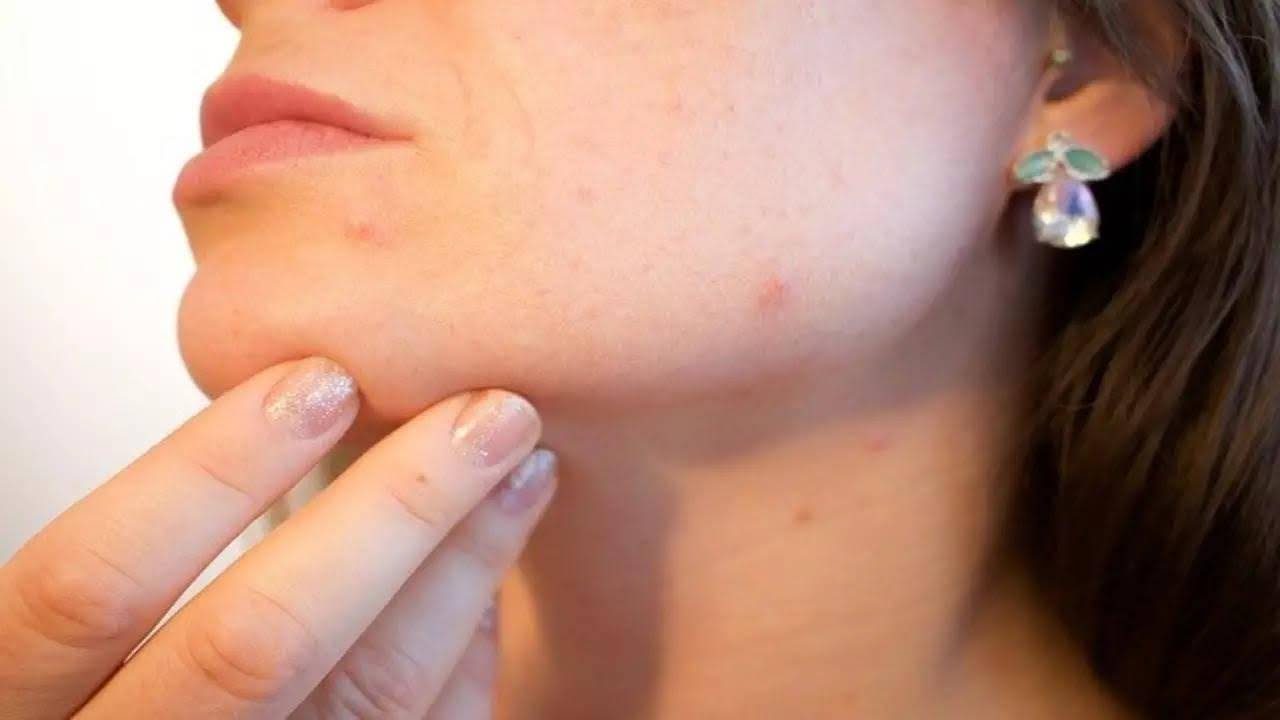 Tìm hiểu nguyên nhân gây mụn do thay đổi nội tiết
