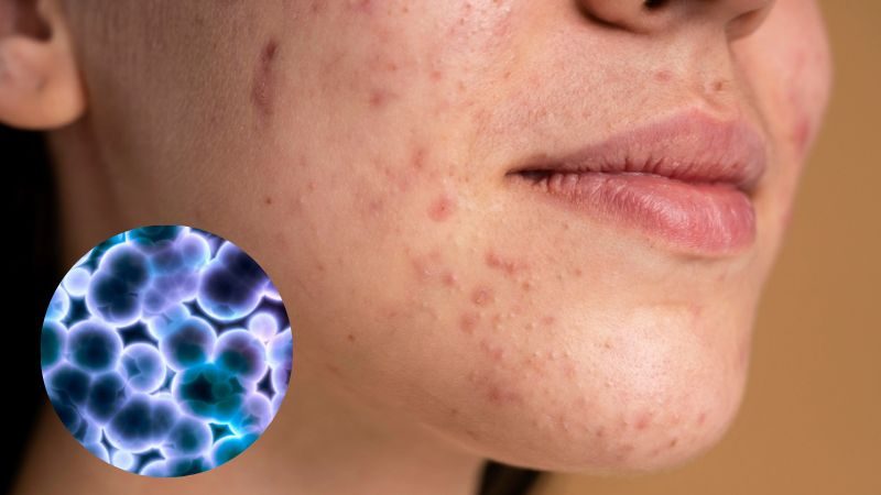 Nguyên nhân gây mụn do vi khuẩn pacnes