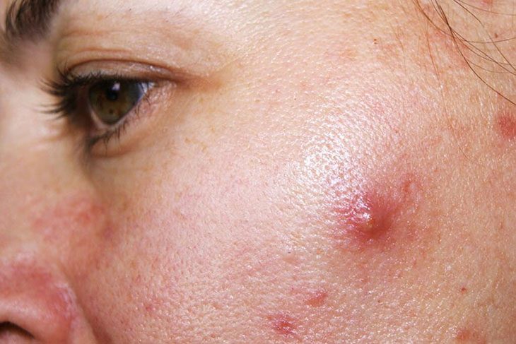 Nhận diện được các yếu tố nguy cơ giúp chúng ta xây dựng chiến lược phòng ngừa và kiểm soát mụn hiệu quả hơn.
